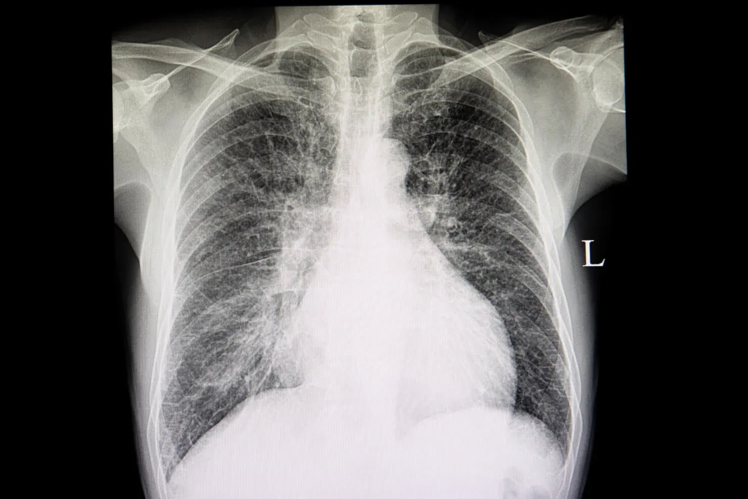 🎓 Session 2 Recap: Chest X-Ray Interpretation & Clinical Application