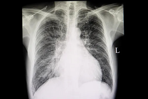 🎓 Session 2 Recap: Chest X-Ray Interpretation & Clinical Application